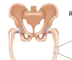 Rickets traced back to Roman Empire