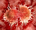 AI tool predicts tumor aggressiveness using protein markers