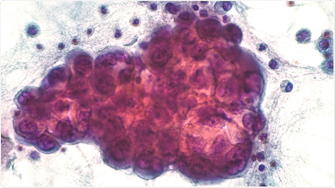 Malignant effusion: Pleural fluid pathology (cytology) of lung (pulmonary) adenocarcinoma, a type of non small cell cancer (carcinoma). Pap stain. Image Credit: David Litman / Shutterstock