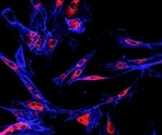 Combination of two cancer drugs could treat the most common form of dementia