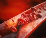 What is Coronary Heart Disease?