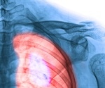 Lung Cancer Risk Factors