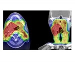 Five microRNAs predict course, recurrence of HPV-negative head and neck cancer