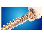 Medtronic announces U.S. launch of Infinity OCT System