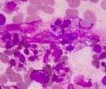 Sepsis and Influenza