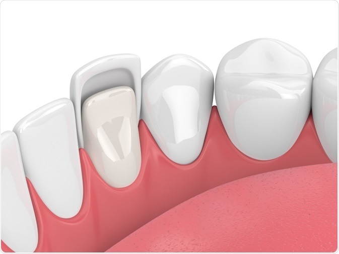 Illustration of veneer covering the tooth - By Aleksandra Gigowska