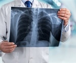 Lung Cancer Questions