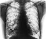 Bronchiectasis Treatment