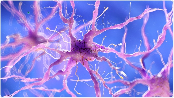 Neurons with amyloid plaques - an illustration of the amyloid cascade hypothesis By Sebastian Kaulitzki Neurons with amyloid plaques - an illustration of the amyloid cascade hypothesis By Sebastian Kaulitzki