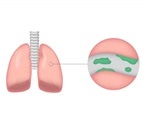 Nontuberculous Mycobacteria Diagnosis