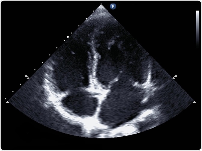 Standard transthoracic two-dimensional echocardiography in a patient with hypertension - picture by kalewa Standard transthoracic two-dimensional echocardiography in a patient with hypertension - picture by kalewa