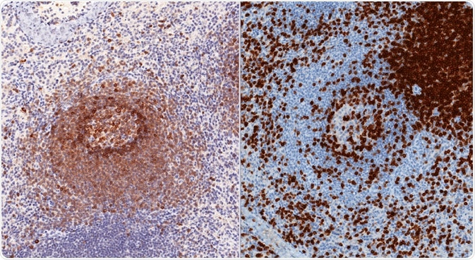 Spleen stained for CD79 (left) and CD3 (right) to show B and T cells - by vetpathologist Spleen stained for CD79 (left) and CD3 (right) to show B and T cells - by vetpathologist