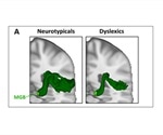Study delves deeper into developmental dyslexia