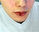 Syphilis Symptoms