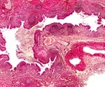What is Bronchiectasis?