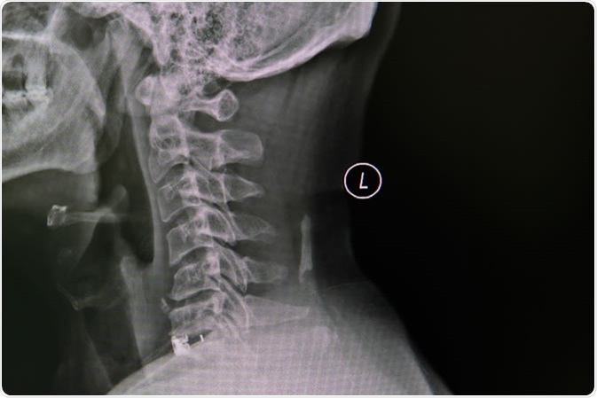 Cervical Spine, spinal cord and spondylosis, impressions with narrowing of the C5 / 6 area - Image Credit: nuiza11 / Shutterstock