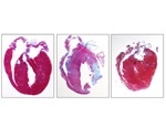 New drug treats inflammation related to inherited heart disease in young athletes