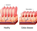 Celiac disease may now be curable with biodegradable nanoparticles