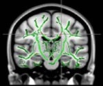 Obese teenagers at risk for brain damage, suggests new study