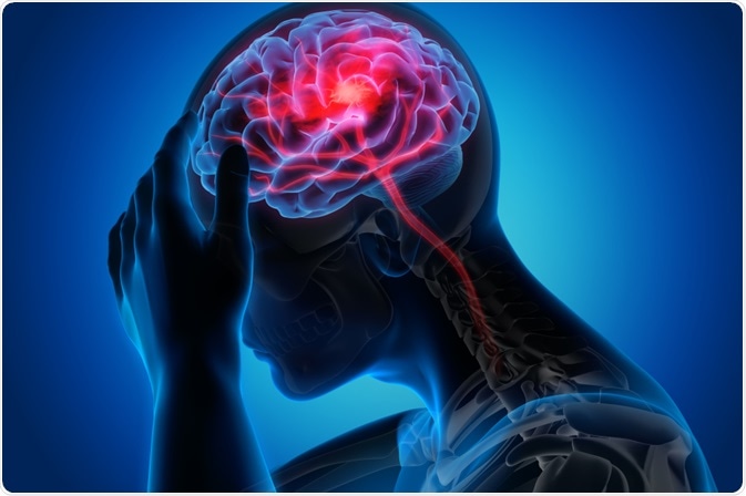 headache