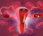 Self-sampling could increase detection of cervical pre-cancer