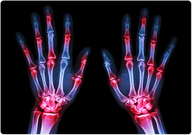 arthritis