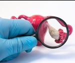 Genetics of Polycystic Ovary Syndrome (PCOS)