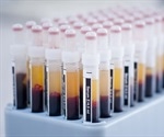 Gastric Volume Reduction Surgery Leads to Blood Serum Proteome Changes
