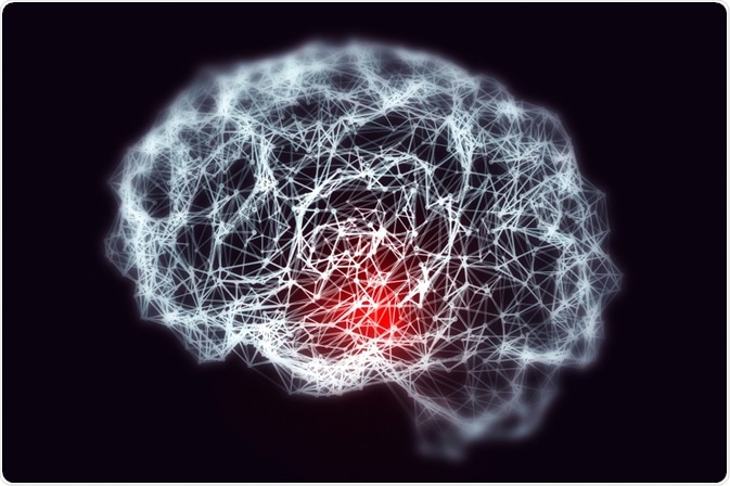 dementia migraines