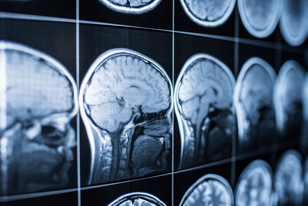 traumatic brain injury