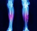 Causes and Symptoms of Bone Cancer