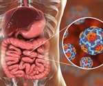 Celiac disease may be caused by gastrointestinal infection in childhood