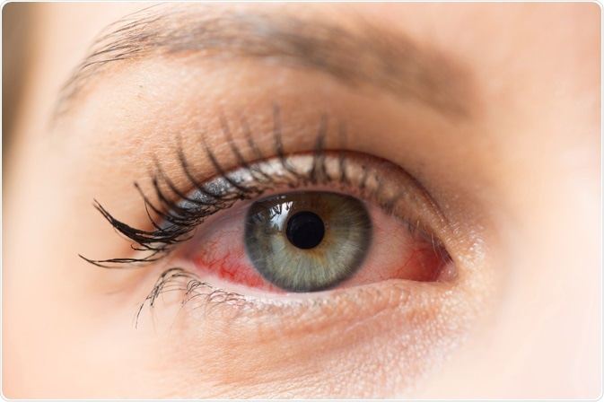 woman with eye allergy - close up photo