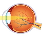 What is Phakic IOL?