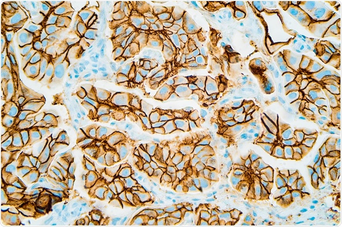 Immunohistochemistry for HER2 shows positive cell membrane staining in this infiltrating ductal carcinoma