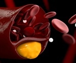 Success for new cholesterol-lowering drug