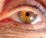 What is Iridodonesis?