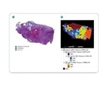 Understanding Cancer Biomarkers: A Focus on N-Glycans