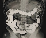 Fluoroscopy Procedure