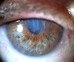 What is Iridoschisis?