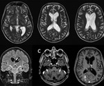 What is Adrenoleukodystrophy?