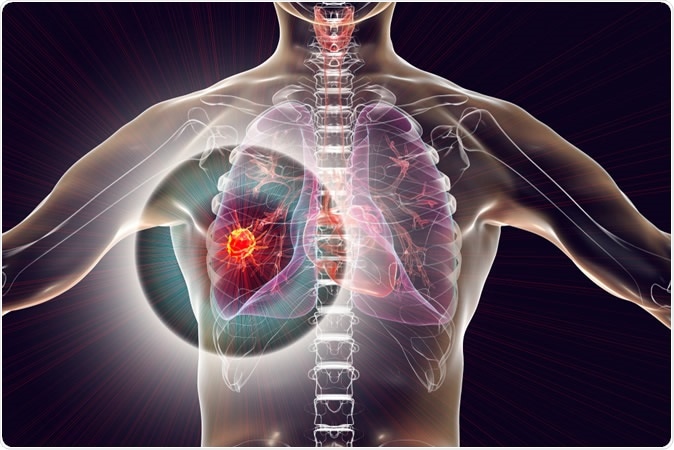 Lung cancer, 3D illustration showing malignant tumour. Image Credit: Kateryna Kon / Shutterstock