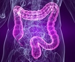 Post-Infectious Irritable Bowel Syndrome