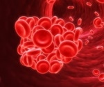Protein C Deficiency