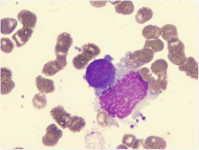 Acute myelofibrosis. Image Credit: LindseyRN / Shutterstock