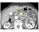 Early removal of some pancreatic cysts could decrease cancer risk, save lives
