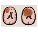 Surgery can be beneficial for one type of primary central nervous system lymphoma