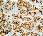A new significance of LVD and angiogenic MVD is identified in human primary SCRC