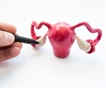 Half of all women with PCOS share a rare gene variant