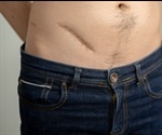 Appendix removal linked to increased risk of Parkinson's disease